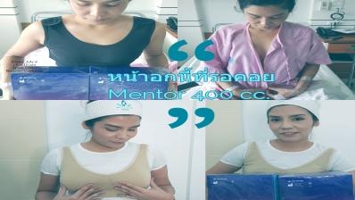 รีวิวเสริมหน้าอก Mentor 400 cc 