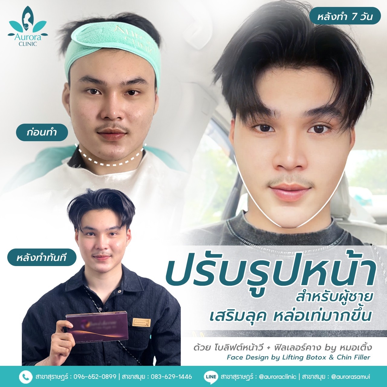 จาก “กล้ามเนื้อที่แข็งแรง” สู่ “กรอบหน้าที่เรียวสวย”: เส้นทางการเปลี่ยนแปลงด้วยโบท็อกซ์