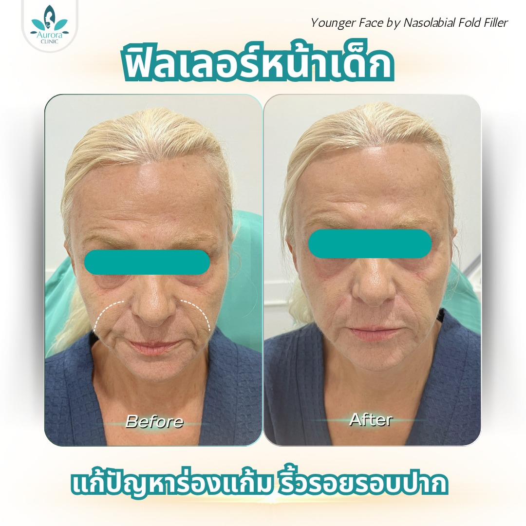 ฟิลเลอร์...เวทมนตร์ที่ช่วยย้อนวัยได้อย่างไร? ฟิลเลอร์...เวทมนตร์ที่ช่วยย้อนวัยได้อย่างไร?