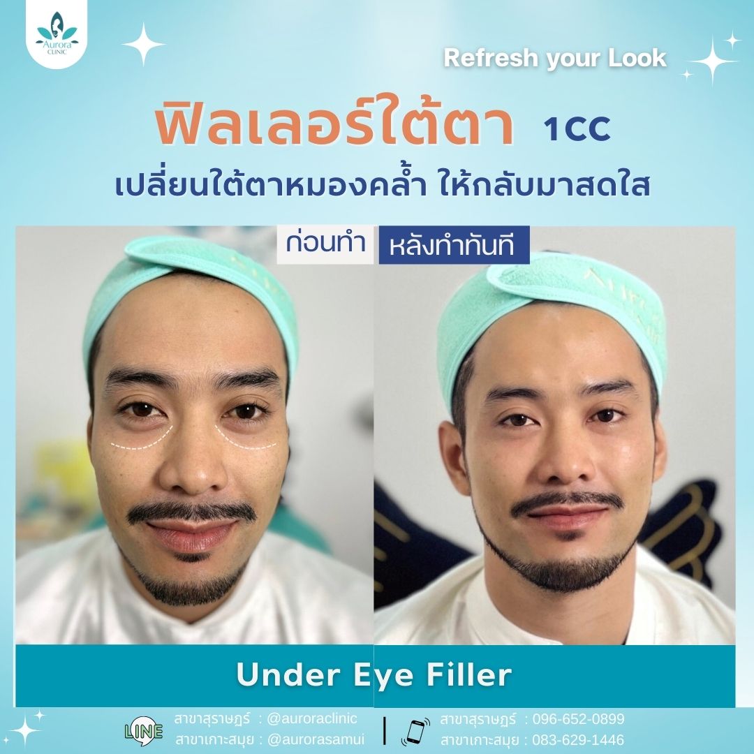 ฟิลเลอร์ใต้ตา (Under Eyes/Tear Troughs) ฟิลเลอร์ใต้ตา (Under Eyes/Tear Troughs)