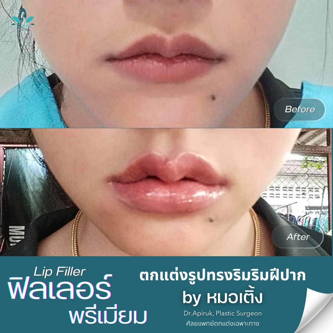 ฟิลเลอร์ริมฝีปาก (Lips) ฟิลเลอร์ริมฝีปาก (Lips)